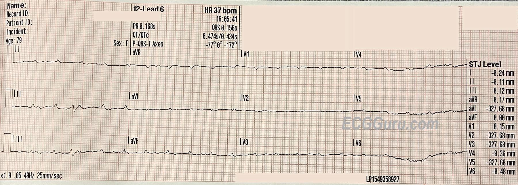 Bifascicular Block Ecg Guru Instructor Resources